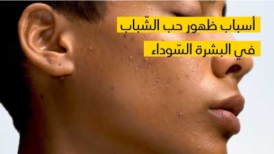   أسباب ظهور حب الشّباب في البشرة السّوداء