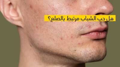 هل حب الشباب مرتبط بالصلع ؟