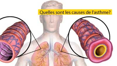 Quelles sont les causes de l