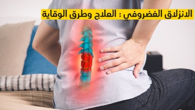 الانزلاق الغضروفي : العلاج وطرق الوقاية