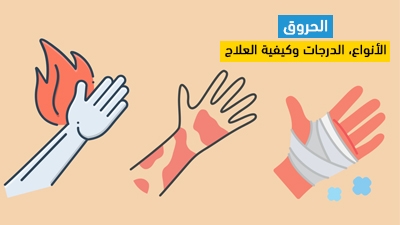 الحروق: الأنواع، الدرجات وكيفية العلاج