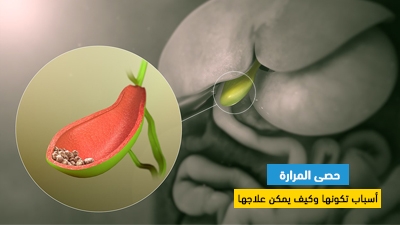 حصى المرارة : أسباب تكونها وكيف يمكن علاجها
