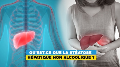 Qu'est-ce que la stéatose hépatique non alcoolique ?