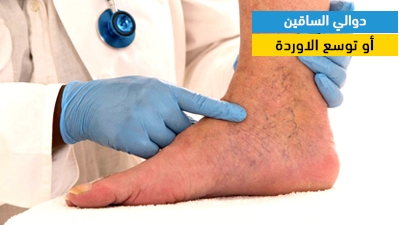 دوالي الساقين أو توسع الدوالي
