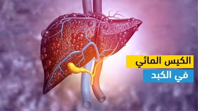 الكيس المائي في الكبد