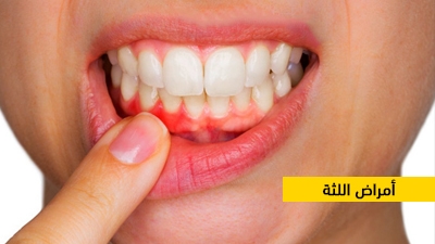 أمراض اللثة