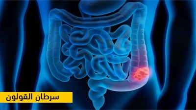 سرطان القولون