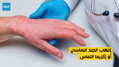 التهاب الجلد التماسي أو إكزيما التماس