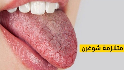 متلازمة شوغرن