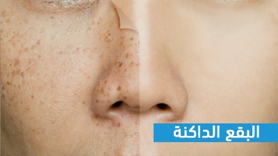 البقع الدكنة