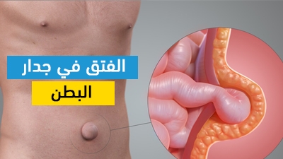 الفتق في جدار البطن