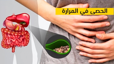 الحصى في المرارة