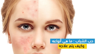 حب الشباب: ما هي أنواعه وكيف يتم علاجه