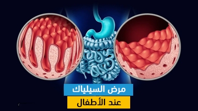 مرض السيلياك عند الأطفال