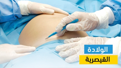 الولادة القيصرية