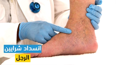 انسداد شرايين الرجل