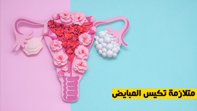 متلازمة تكيس المبايض