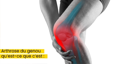 Arthrose du genou qu’est-ce que c’est :