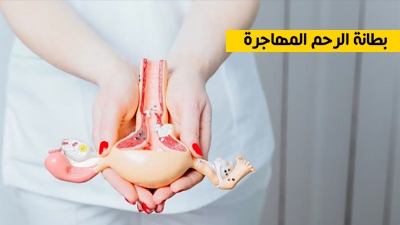 بطانة الرحم المهاجرة