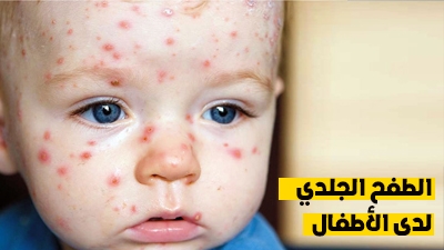 الطفح الجلدي لدى الأطفال