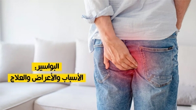 البواسير: الأسباب والأعراض والعلاج