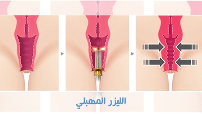 الليزر المهبلي