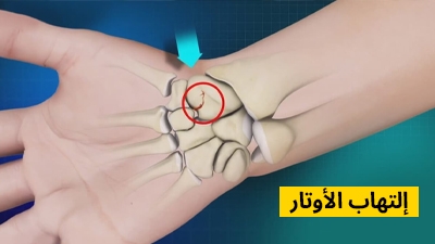 التهاب الأوتار