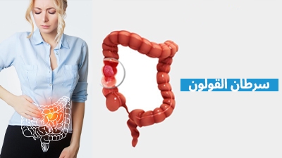سرطان القولون