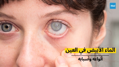 الماء الأبيض في العين : أنواعه وأسبابه