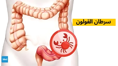 سرطان القولون