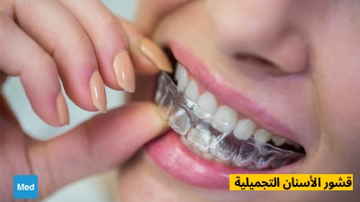 قشور الأسنان التجميلية