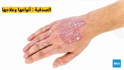 الصدفية : أنواعها وعلاجها