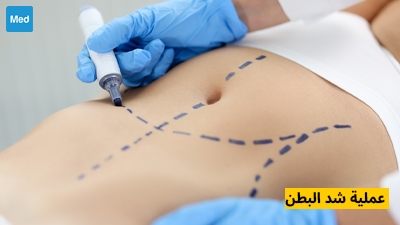 عملية شد البطن