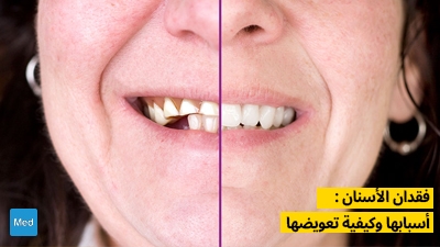 فقدان الأسنان : أسبابها وكيفية تعويضها