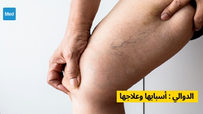 الدوالي : أسبابها وعلاجها