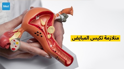 متلازمة المبيض المتعدد الكيسات