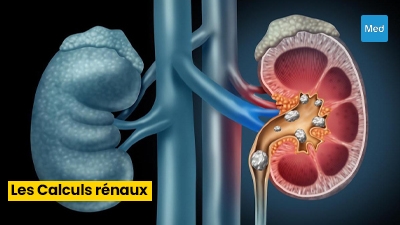 La Lithiase Urinaire : De la Chirurgie à la Prévention 