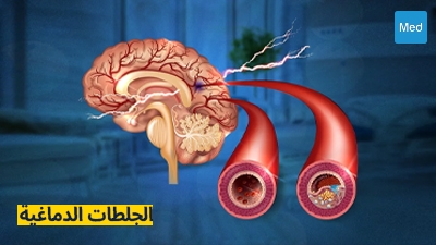 الجلطات الدماغية: الأسباب، الأعراض، التشخيص، والعلاج