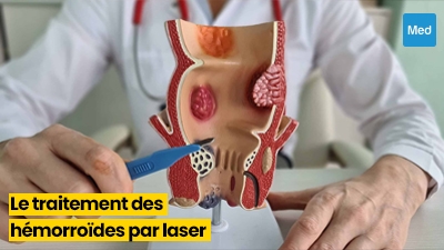Révolution dans le Traitement des Hémorroïdes : La Thérapie au Laser