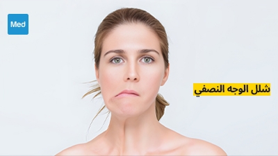 شلل الوجه النصفي