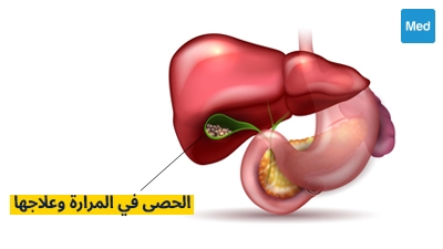الحصى في المرارة وعلاجها