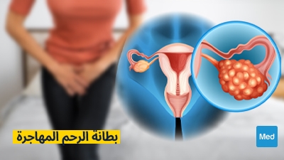 بطانة الرحم المهاجرة