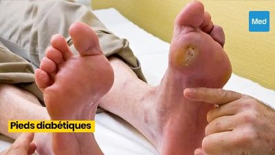 Prendre soin de ses pieds quand on est diabétique : Une étape cruciale pour une vie saine