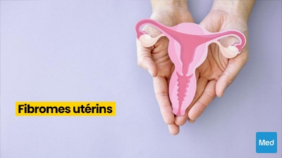 Fibromes utérins : définition, symptômes, diagnostic et traitement