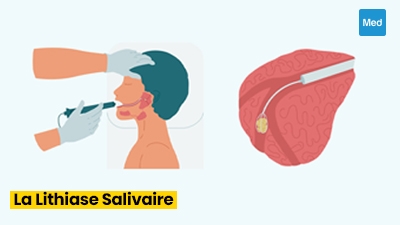 Lithiase salivaire : causes, symptômes et traitements