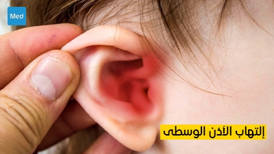 التهاب الأذن الوسطى