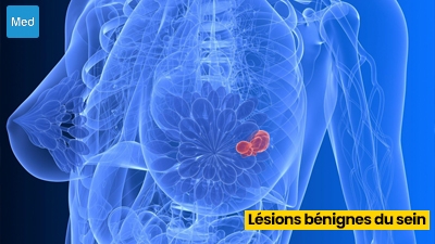 Lésions bénignes du sein