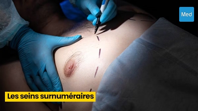 Les seins surnuméraires