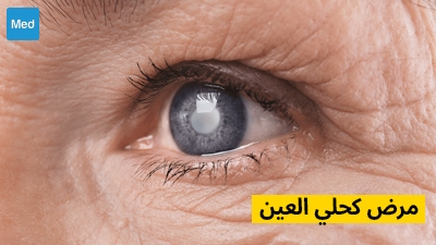 مرض كحلي العين