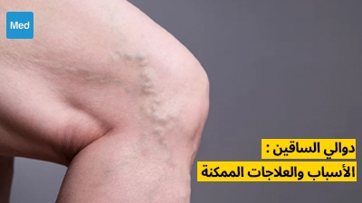 دوالي الساقين : الأسباب والعلاجات الممكنة